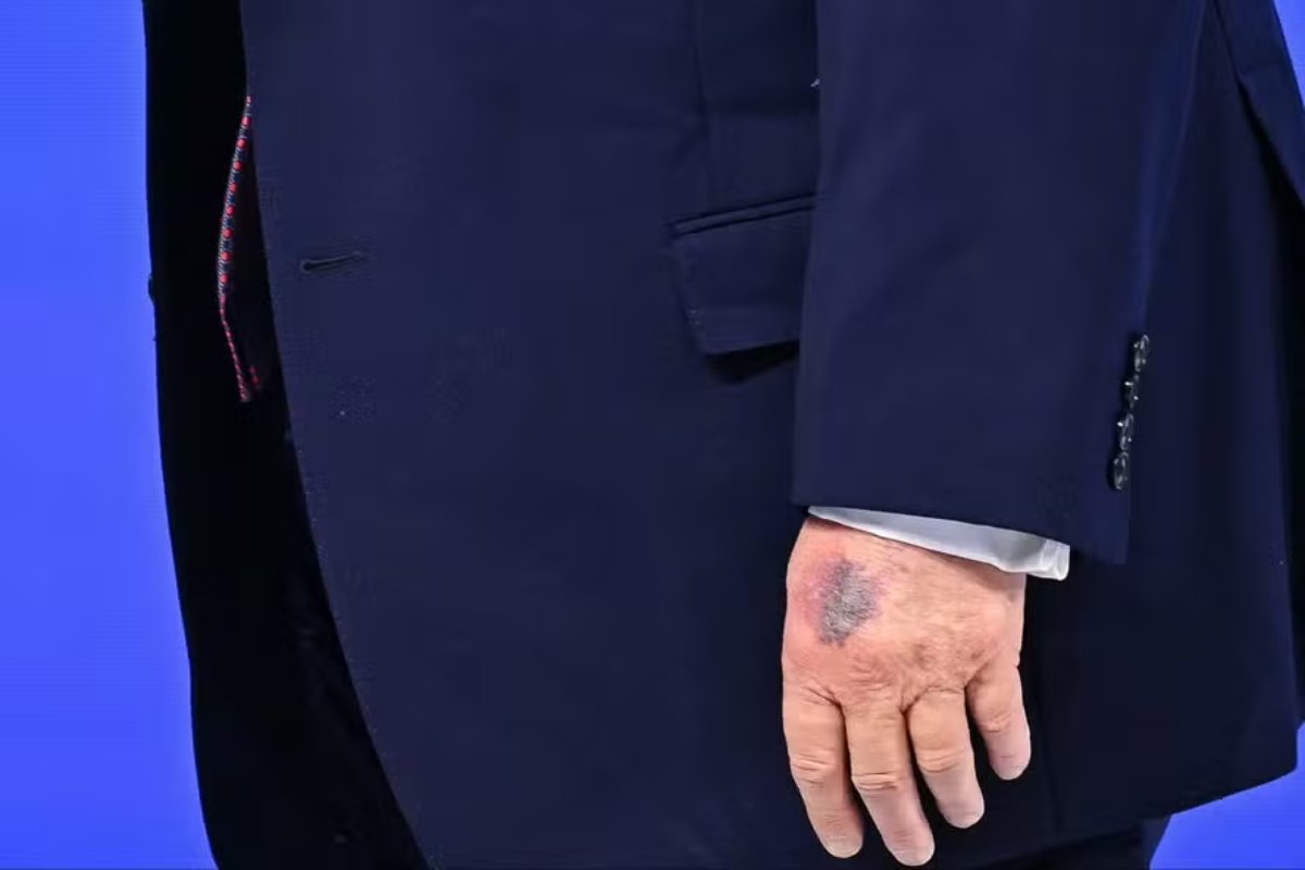 Hematoma na mão de Trump chama atenção de internautas e assessoria do presidente aponta acidente