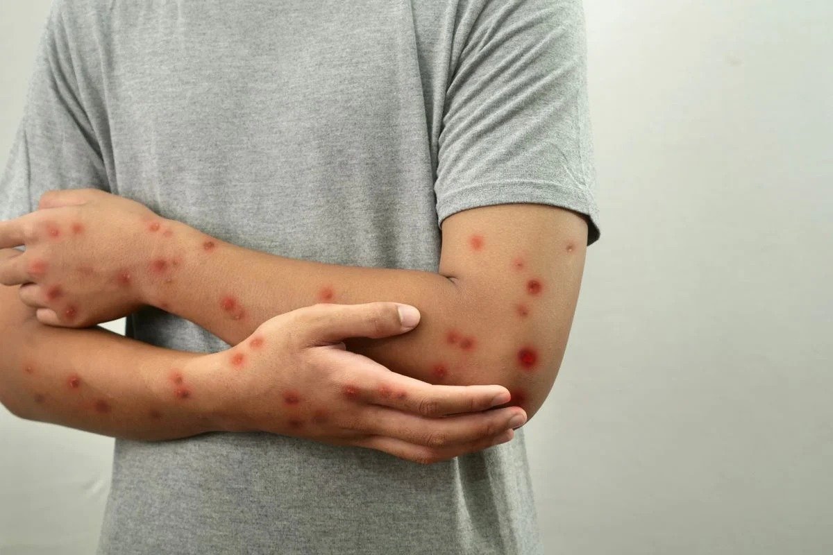 Bahia registra dois casos de Mpox em 2026, diz Sesab