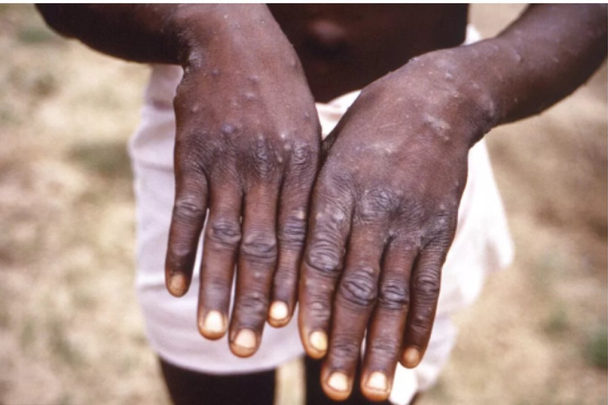 Mpox: reconhecer sinais suspeitos e procurar atendimento precoce é fundamental, recomenda dermatologista! 