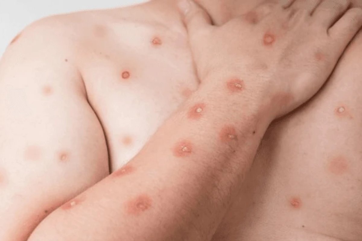 Brasil registra 88 casos confirmados de mpox em 2026; São Paulo concentra a maioria dos registros