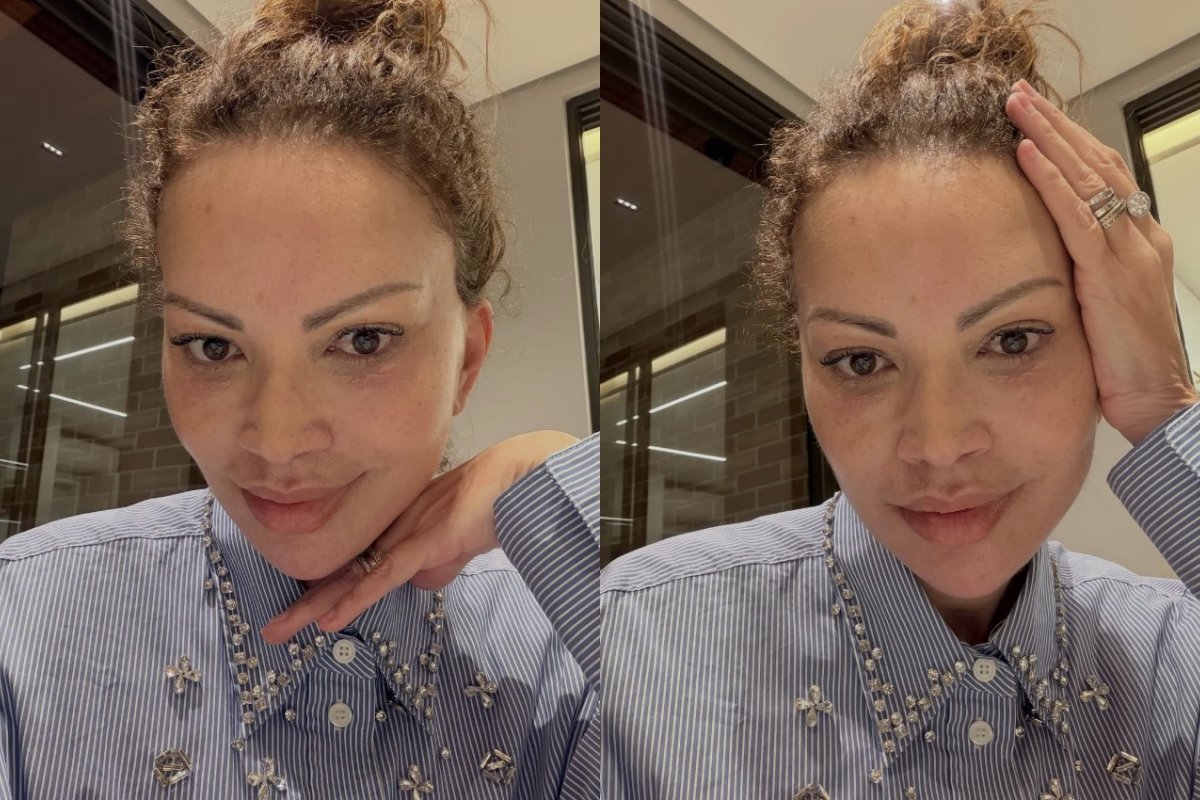 Solange Almeida revela lifting facial completo e especialista explica técnica que vem ganhando destaque no rejuvenescimento! 