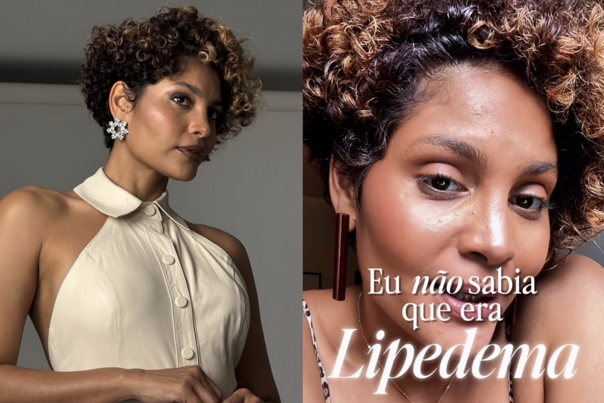 “Por anos, achei que era só meu corpo”: Bárbara Reis fala sobre diagnóstico de lipedema!