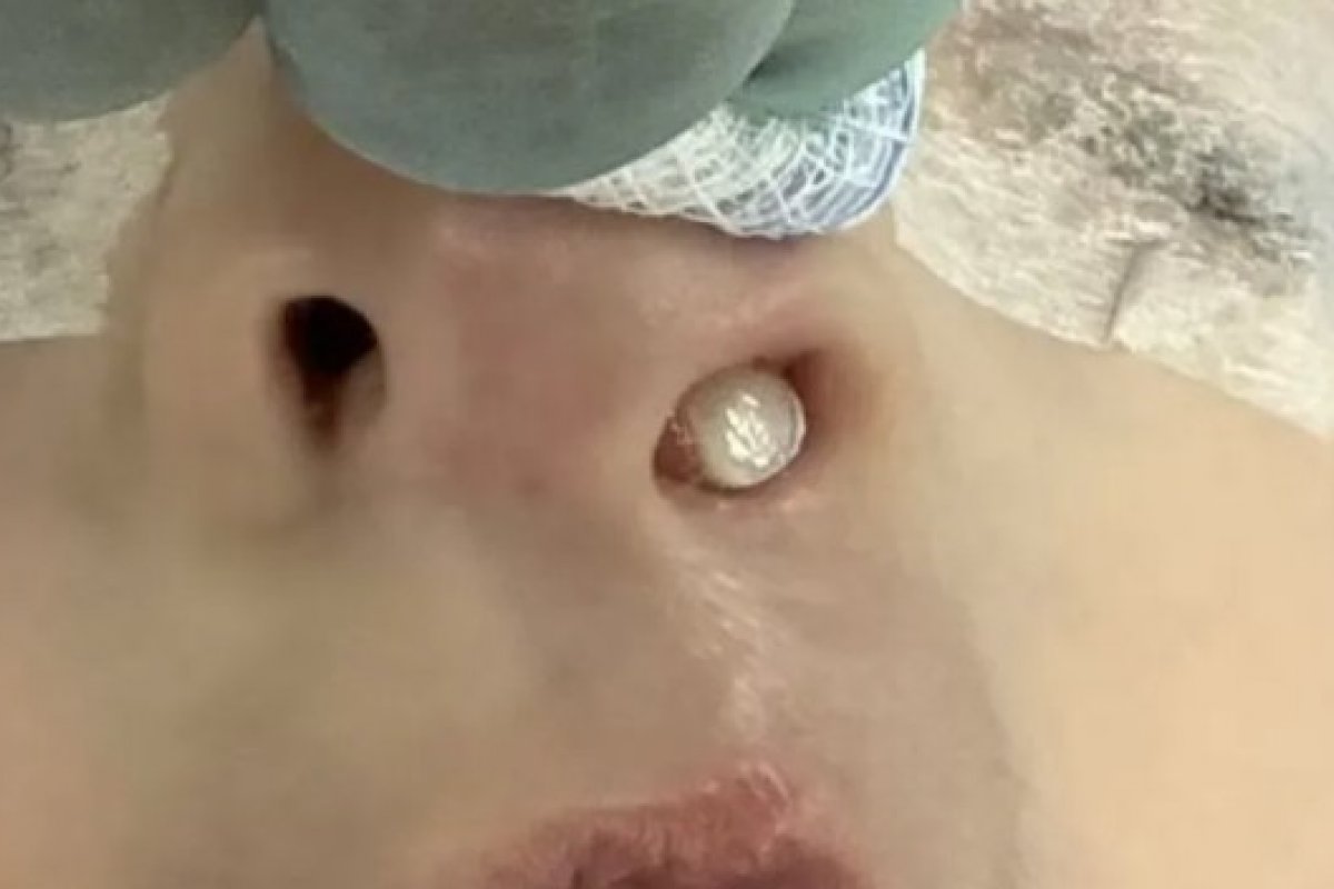Em caso raro, dente nasce no nariz de criança de três anos