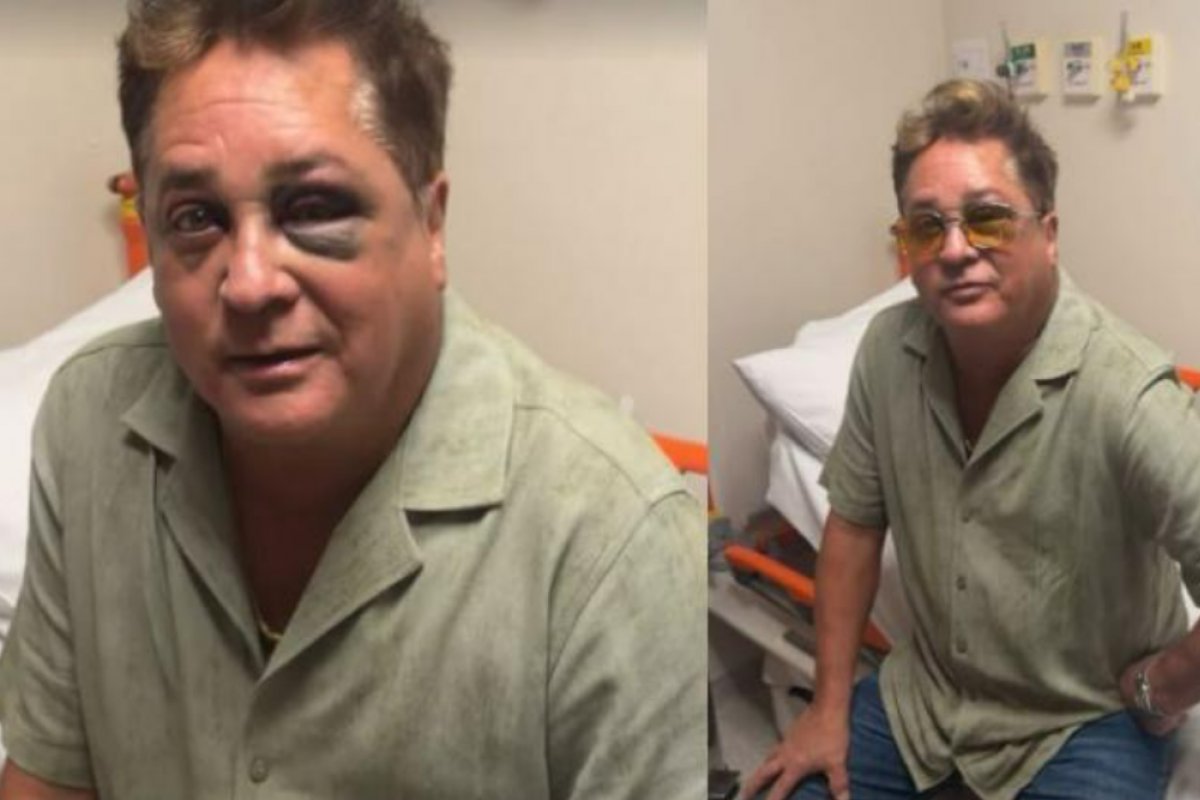 Blefaroplastia: acidente do cantor Leonardo levanta dúvidas sobre cuidados após a cirurgia! 