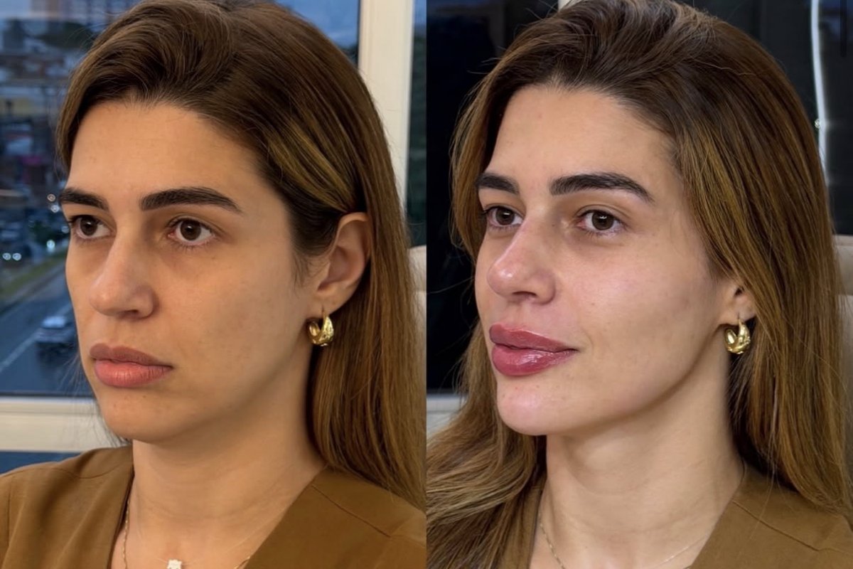 O que mudou no rosto de Vivian Amorim? Especialista comenta resultado! 