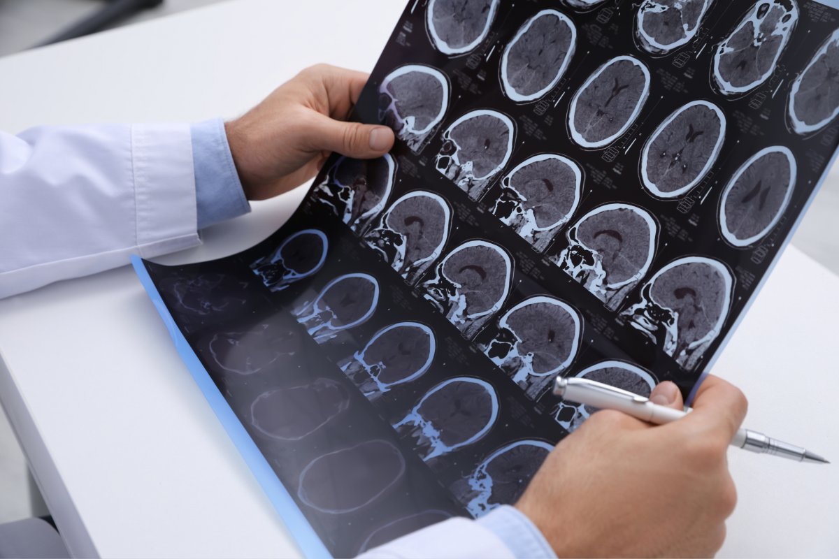 Esclerose múltipla é a principal causa de incapacidade neurológica em jovens adultos!
