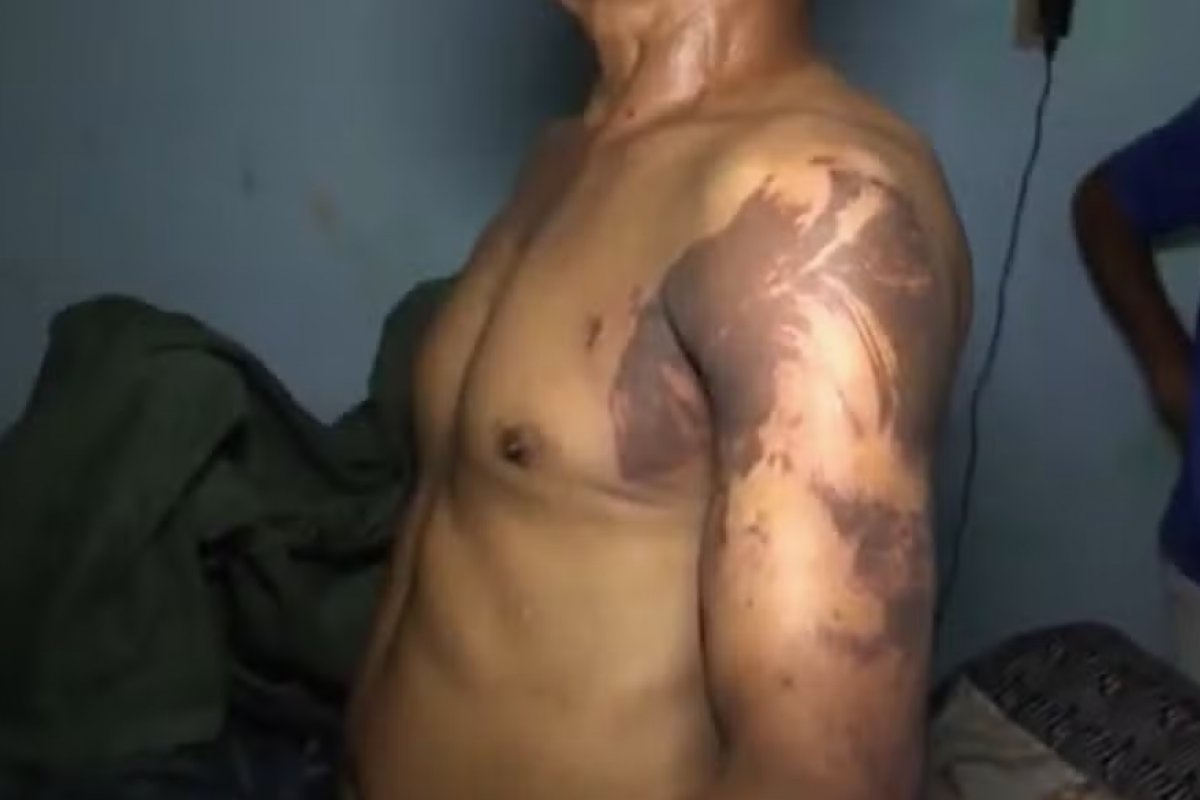 Homem é preso por jogar líquido similar a ácido em três pessoas da mesma família na Bahia