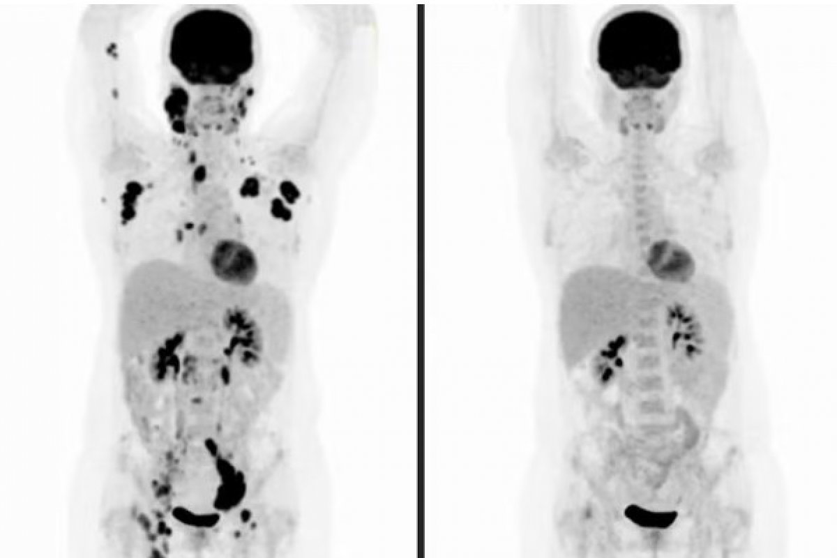 Brasil vai testar 1ª vacina de mRNA em humanos após aprovação da Anvisa