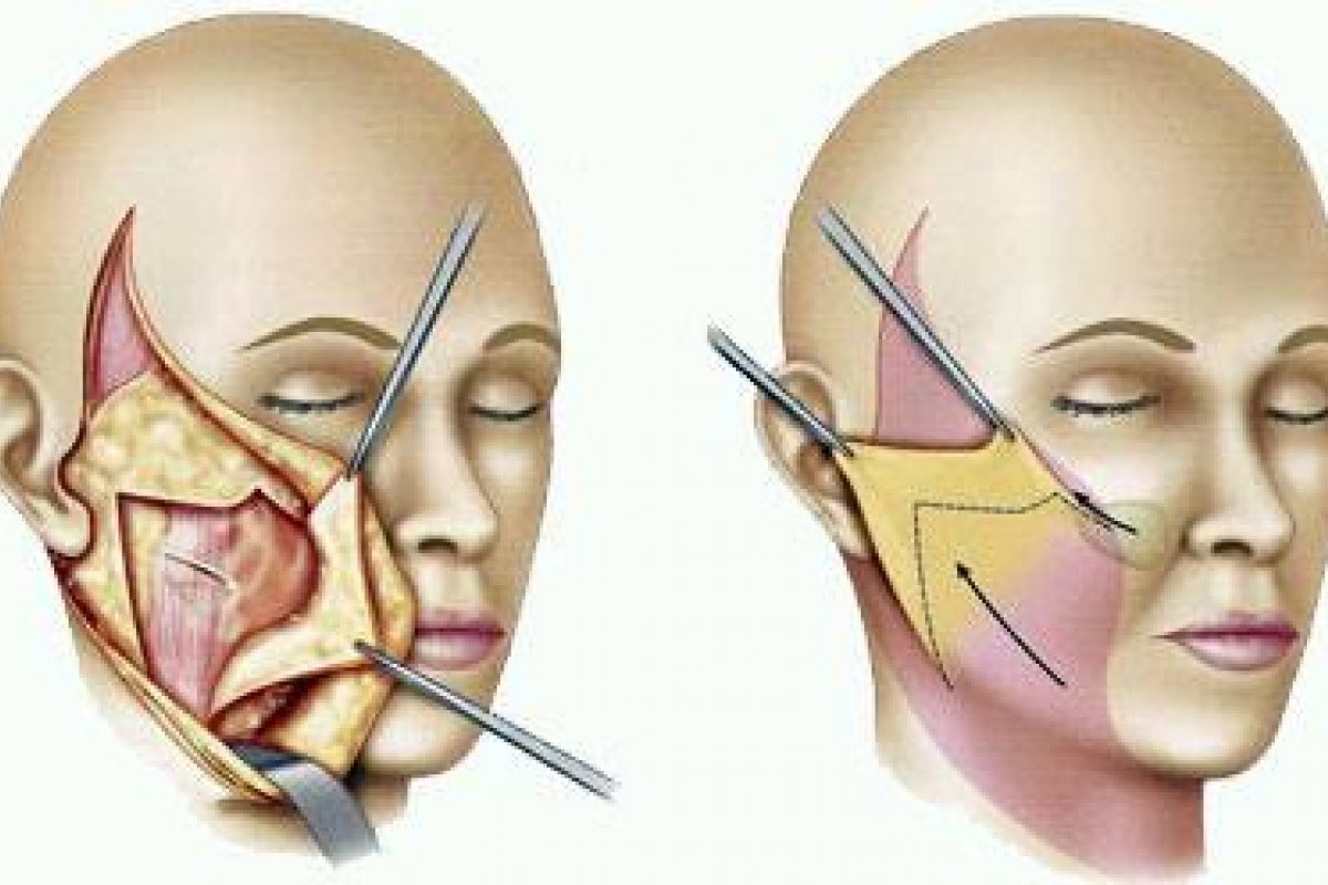 Lifting facial ganha espaço entre pacientes mais jovens em Salvador!