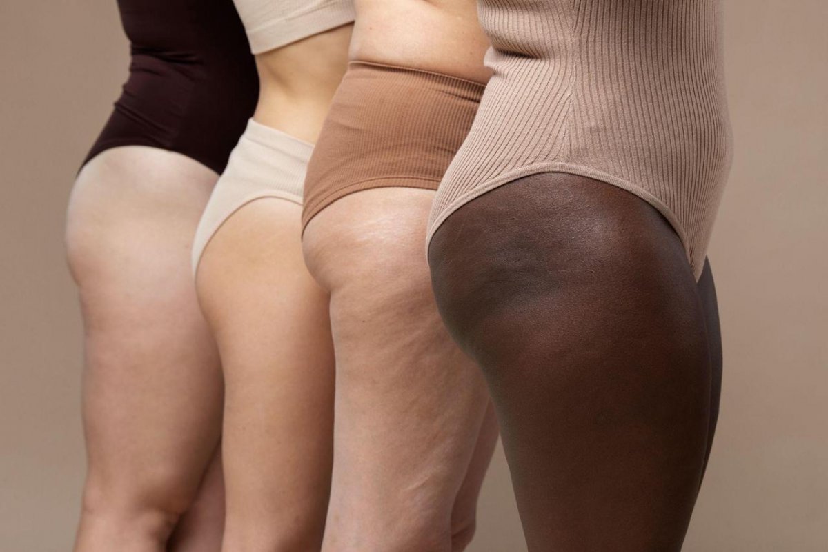 Emagreceu, mas as pernas continuam volumosas? Médica explica quando a desproporção corporal pode ser sinal de lipedema!