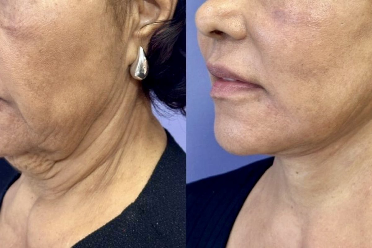 Cirurgião plástico baiano explica tudo sobre o lifting de pescoço Deep Neck! 