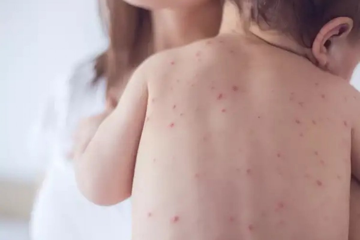Negacionismo impulsiona sarampo nos EUA e representa ameaça ao Brasil