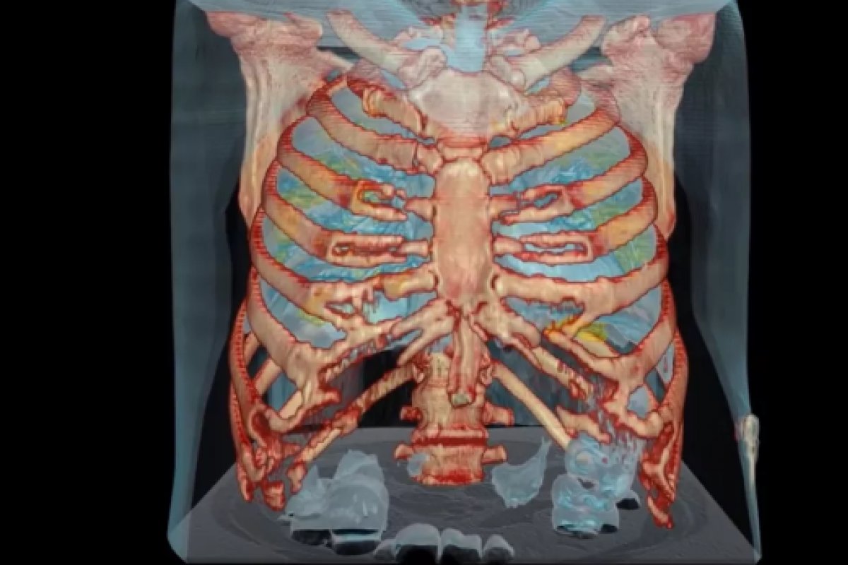 Médicos compartilham vídeo que mostra danos do coronavírus nos pulmões de um paciente
