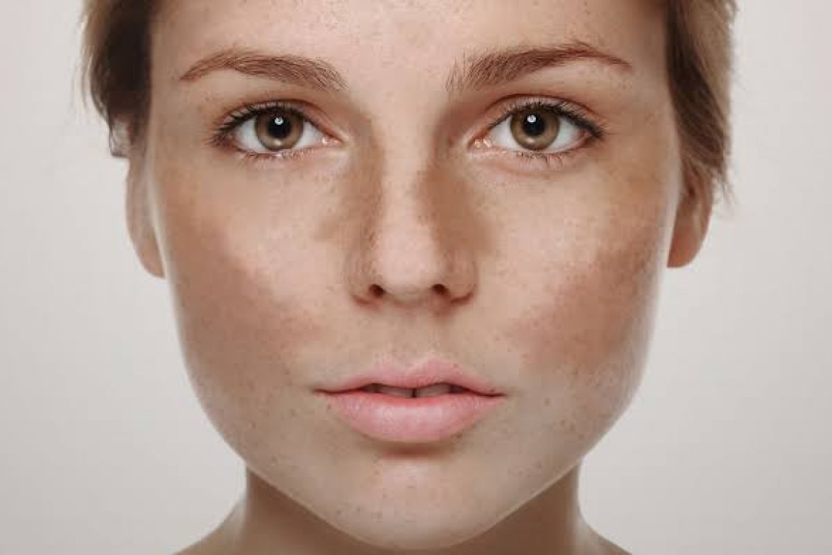 Manchas escuras no rosto? Entenda como minimizar o melasma