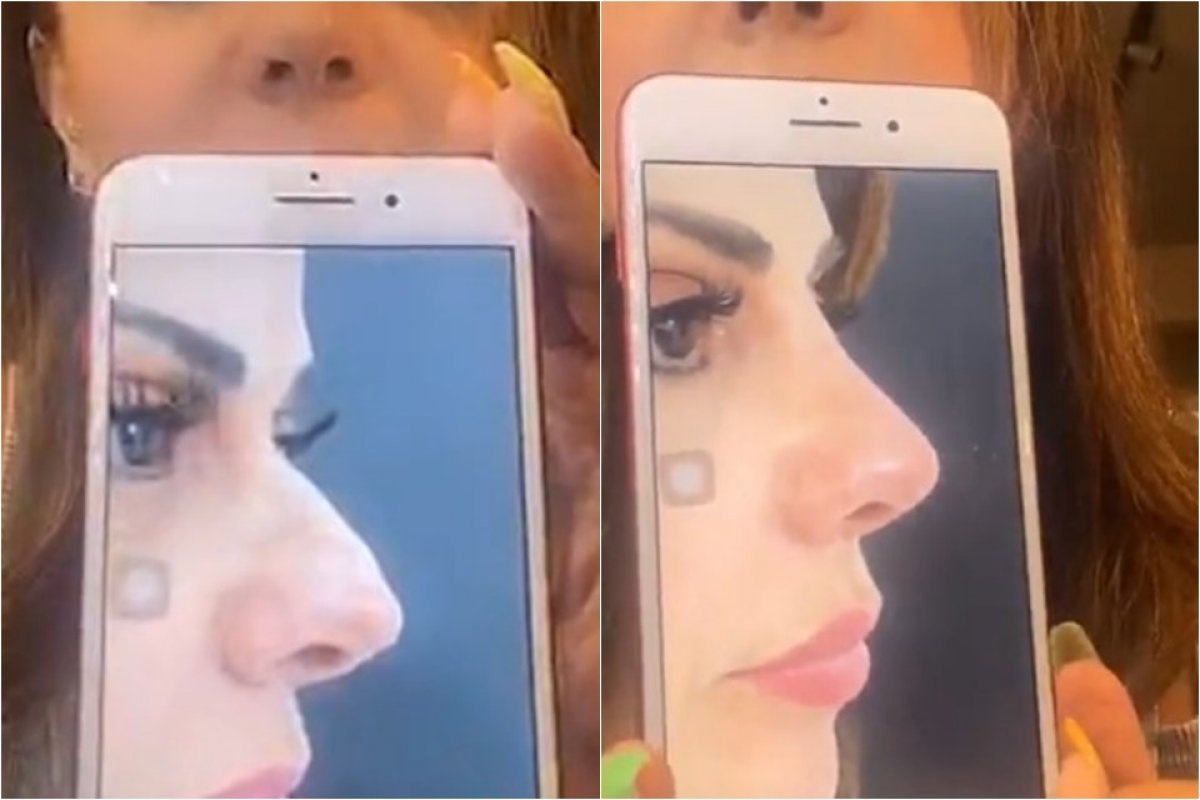 Viviane  Araújo passa por rinoplastia e mostra o resultado: “Me incomodava”