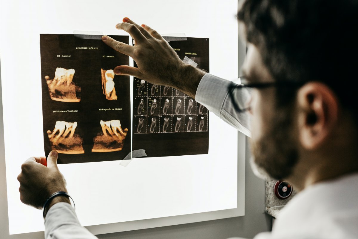 Conheça 11 mitos e verdades sobre o implante dentário