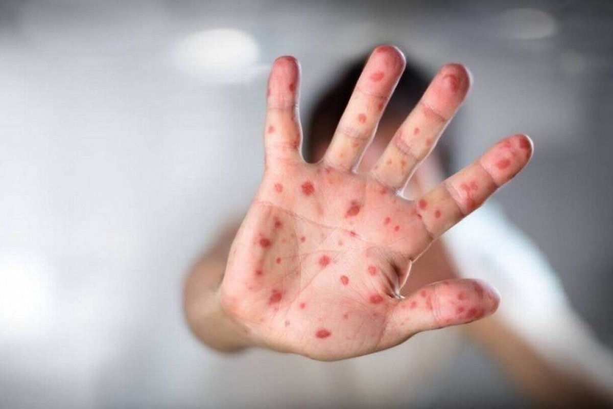 Sarampo avança em meio a pandemia da Covid e provoca mortes no Brasil por falta de vacinação