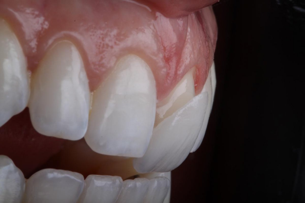  O que são lentes de contatos dentárias? Saiba tudo sobre esse procedimento