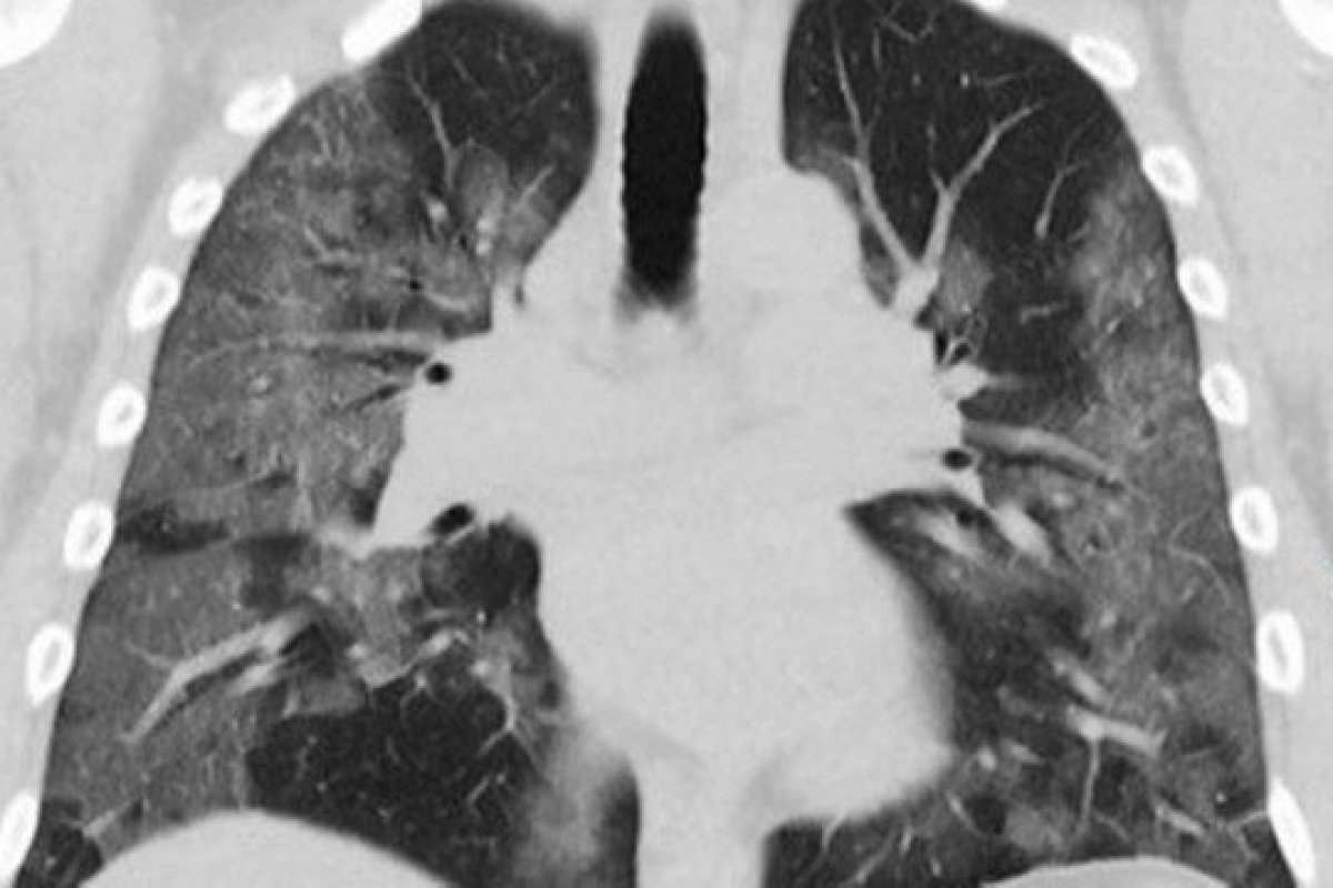 Paciente transplantada morre após receber pulmões infectados com a covid-19