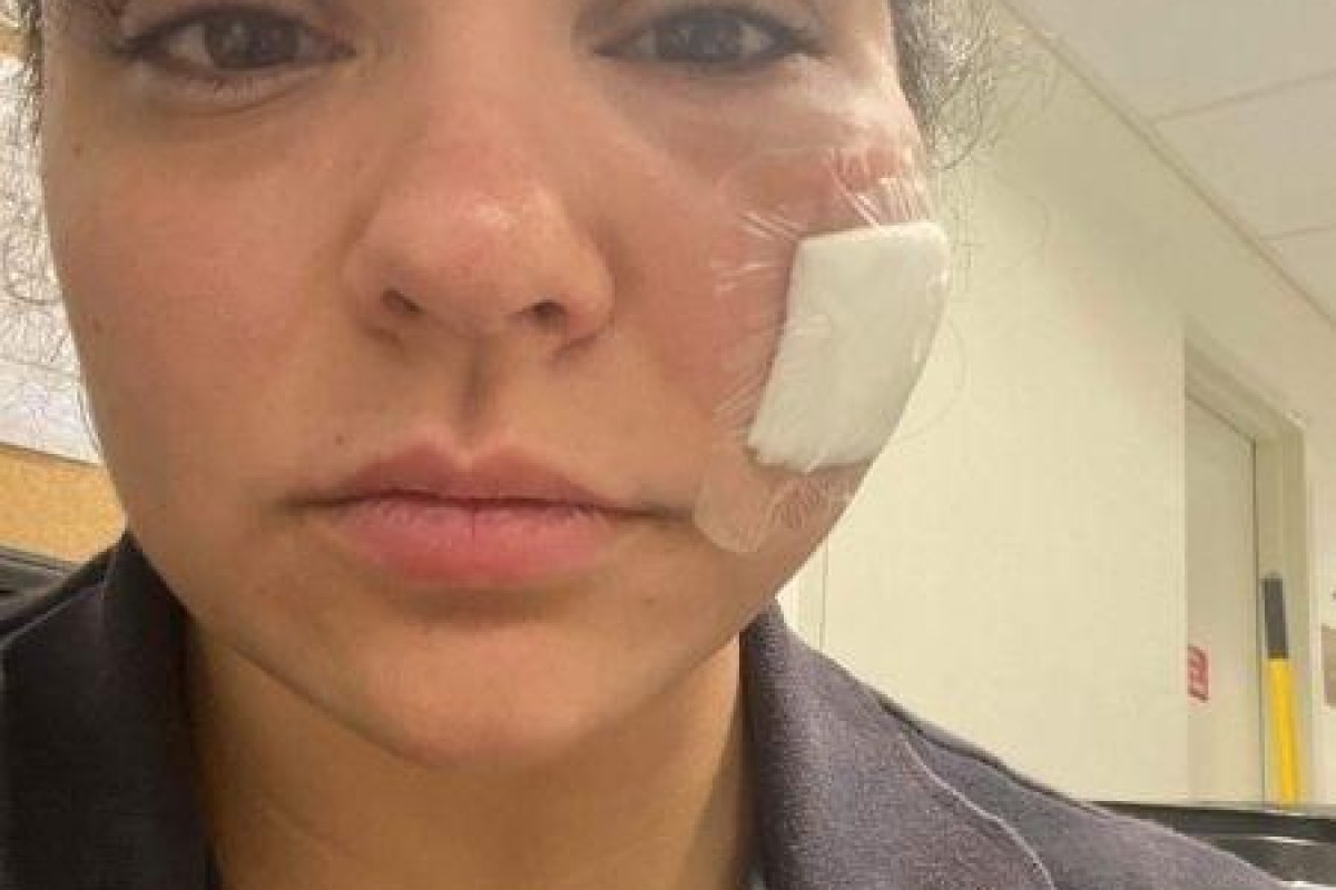Paramédica é atacada com uma mordida no rosto enquanto realizava atendimento 