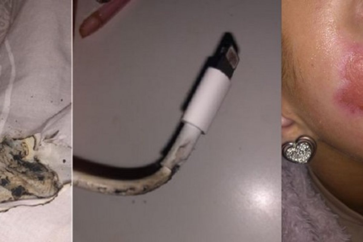 Carregador de iPhone pega fogo e queima rosto da dona do aparelho