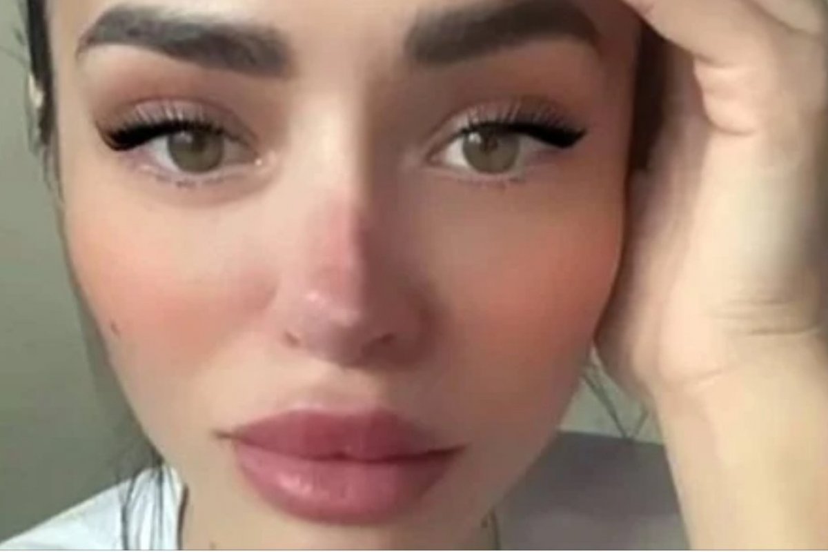 Tragédia! Influencer mostra nariz apodrecendo após cirurgia fracassada! 