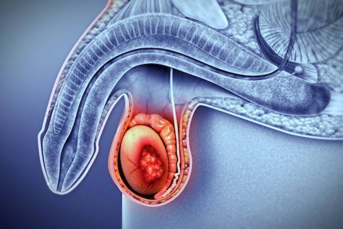 Câncer de testículo: autoexame ajuda a identificar sinais precoces de infecções, inclusive, de tumor! 