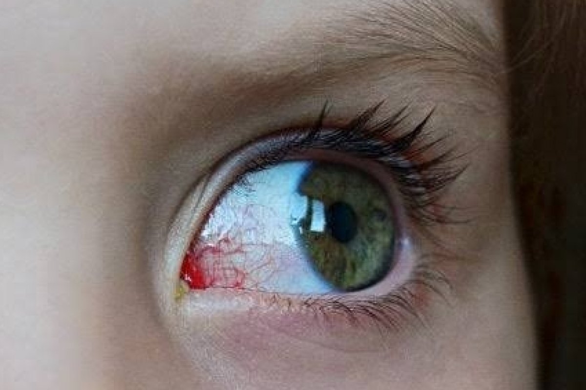  Dor de cabeça e queixas visuais podem indicar glaucoma juvenil
