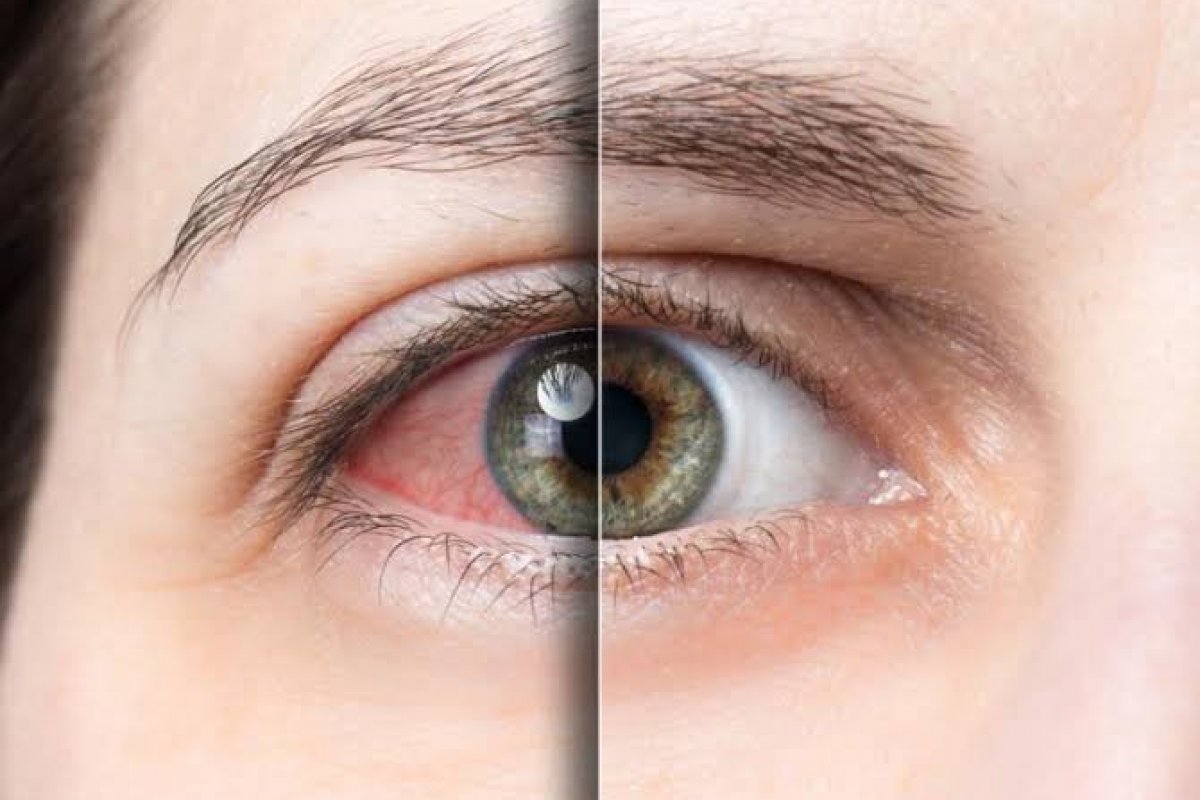 Olho seco pode afetar 6 em cada 10 pacientes com glaucoma