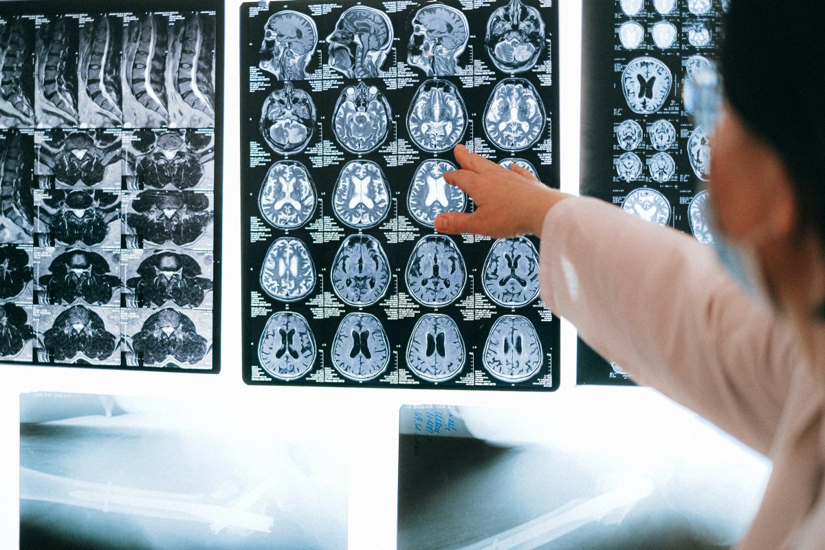 Cientistas de Harvard descobrem indicador precoce para o desenvolvimento do Alzheimer