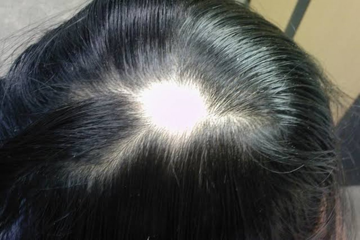 Setembro – Mês da Conscientização da Alopecia  