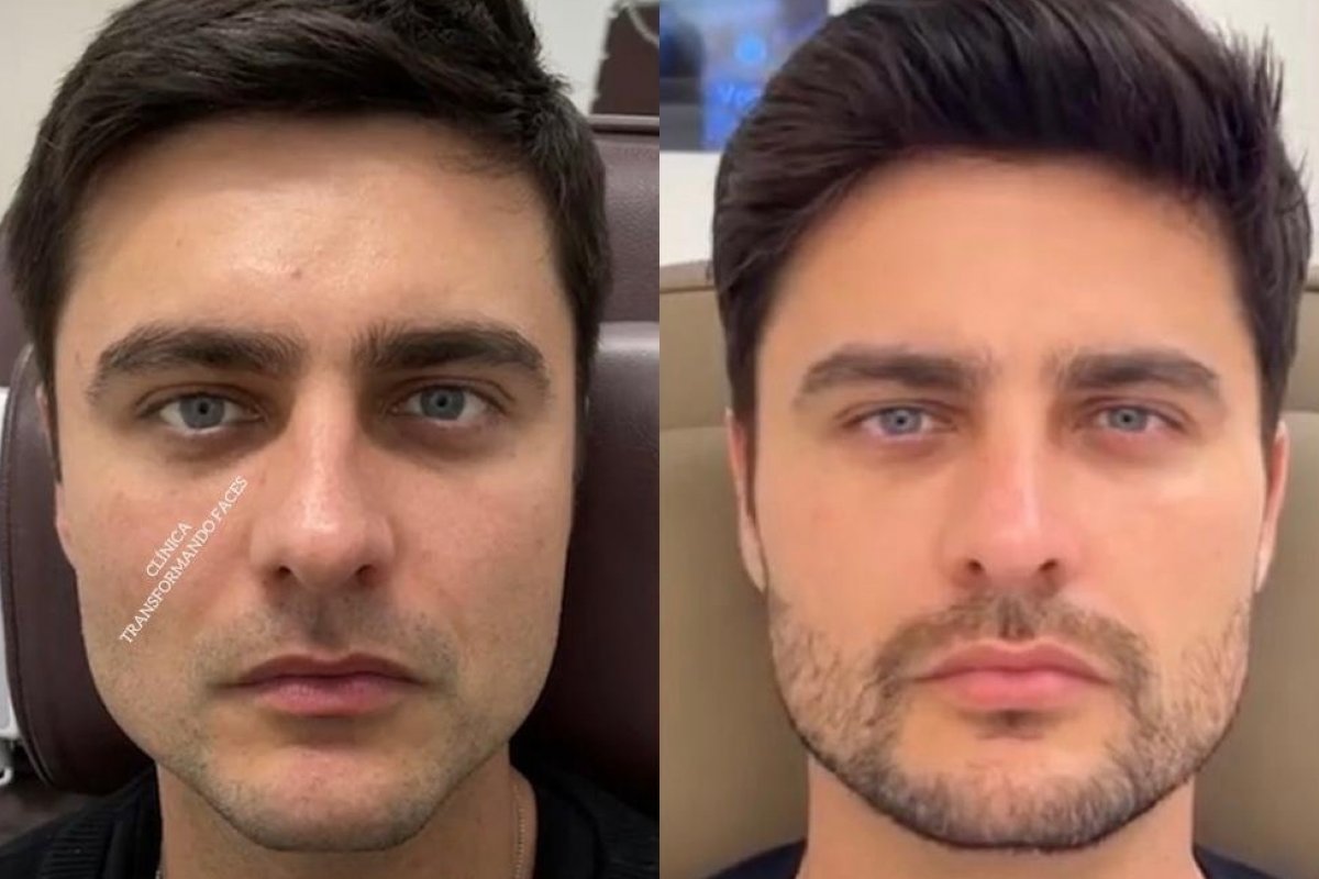 Ator Guilherme Leicam realiza Harmonização Full Face em clínica de Belo Horizonte