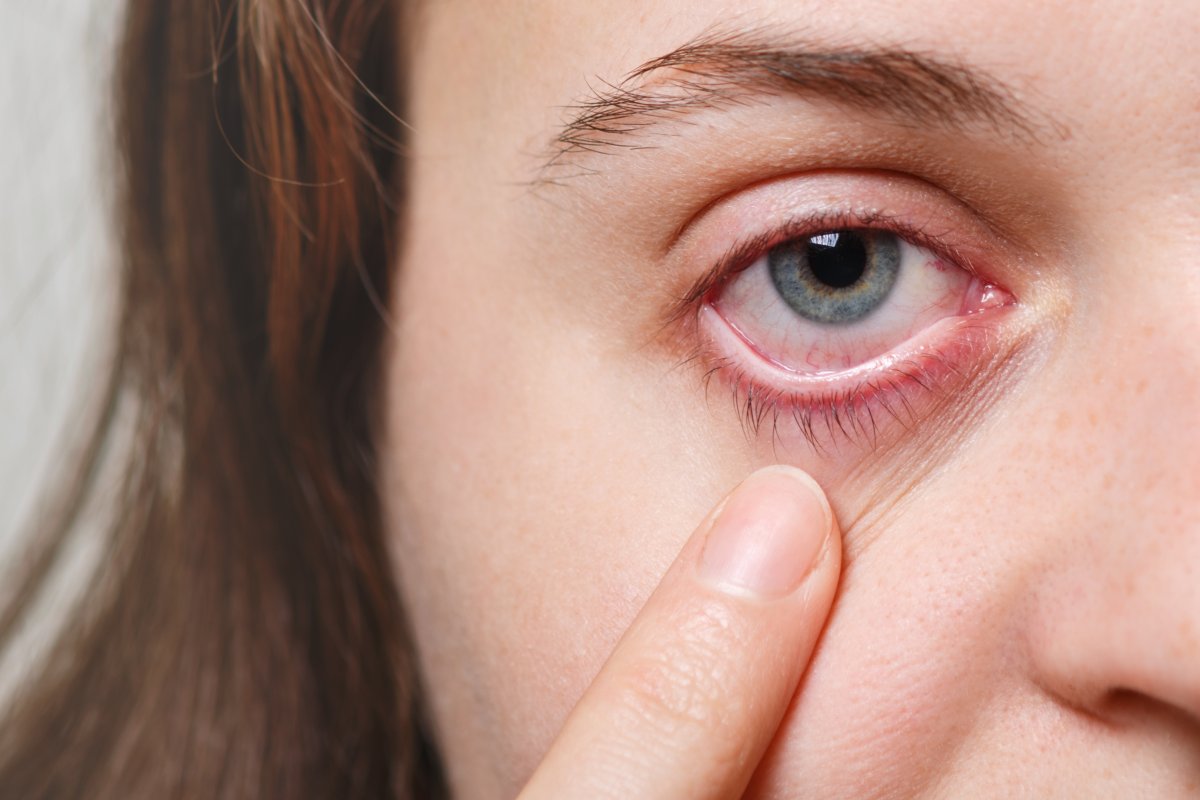 [Doenças oculares aumentam cerca de 20% no Verão; conjuntivite é uma das principais ocorrências! ]