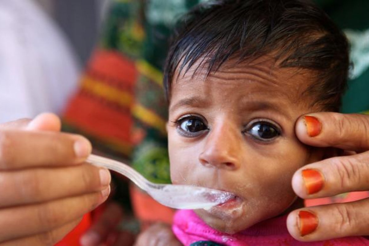 [Unicef chama atenção para desnutrição severa infantil ]