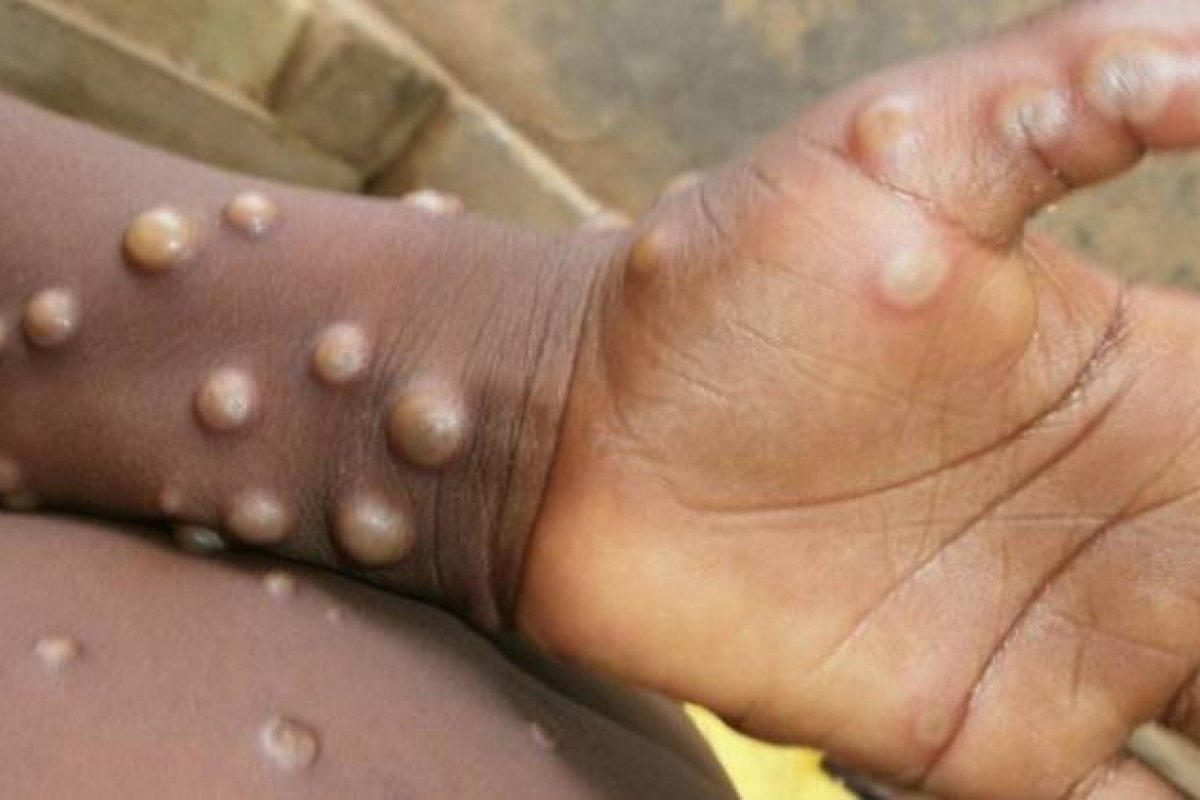 [EUA confirma primeiro caso de 'varíola de macaco' no país]