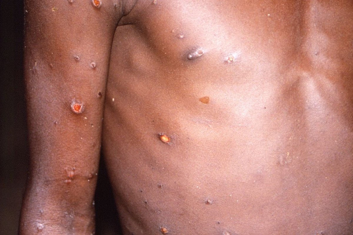 [Ministério da Saúde confirma dois novos casos de varíola dos macacos no país]