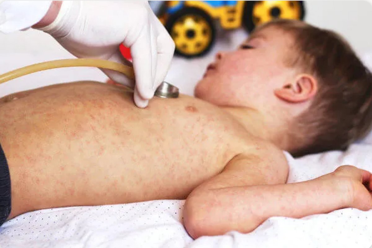[Ministério de Saúde vai monitorar casos de sarampo no país]