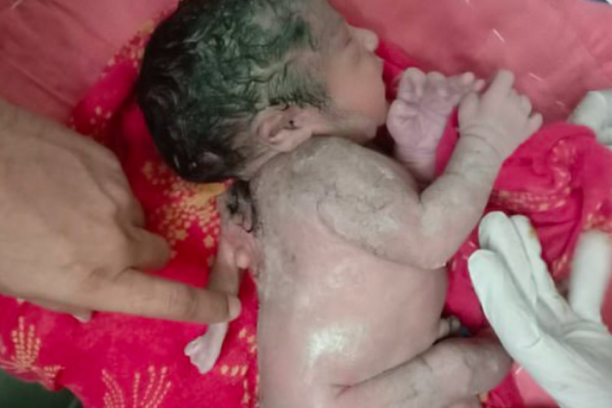 [Bebê nasce com três mãos em raro caso de polimelia na Índia]