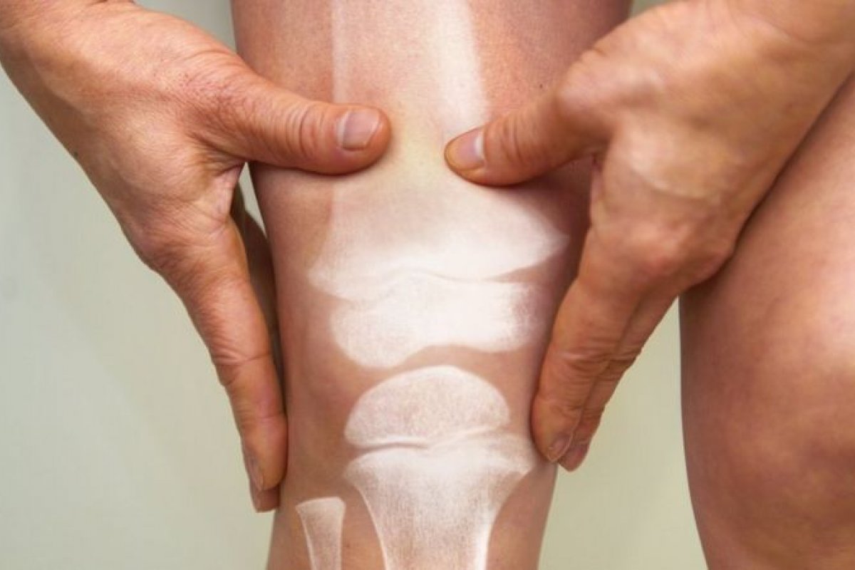 [Osteoporose nos homens pode levar a complicações mais graves devido ao diagnóstico tardio]