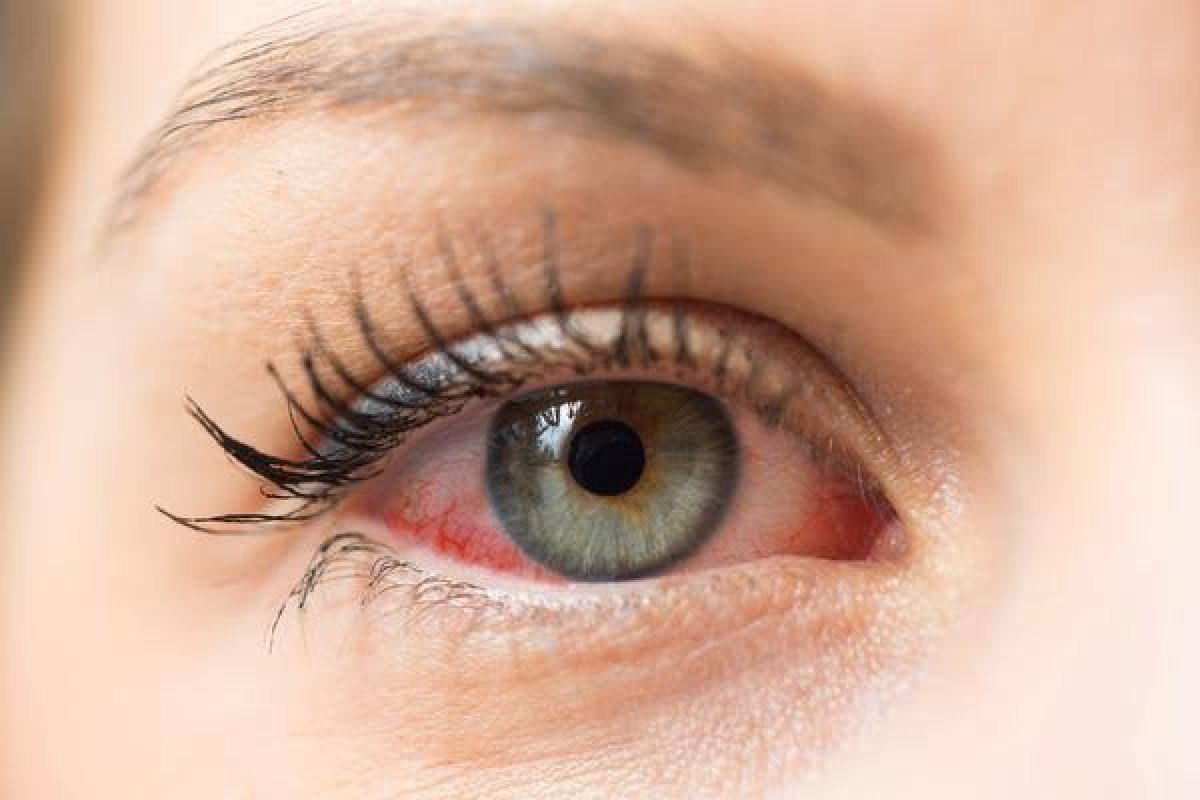 [Sono ruim aumenta risco de glaucoma em até 20%,diz estudo! ]