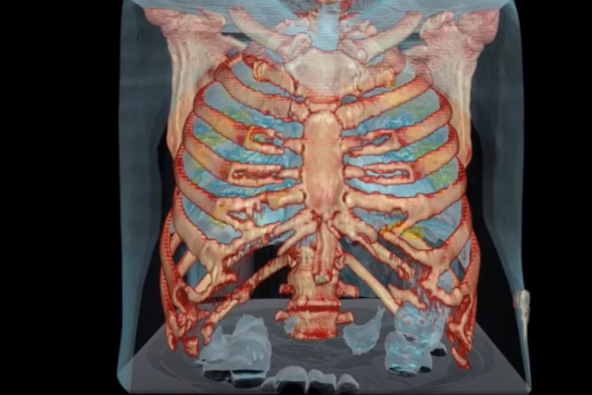 [Médicos compartilham vídeo que mostra danos do coronavírus nos pulmões de um paciente]